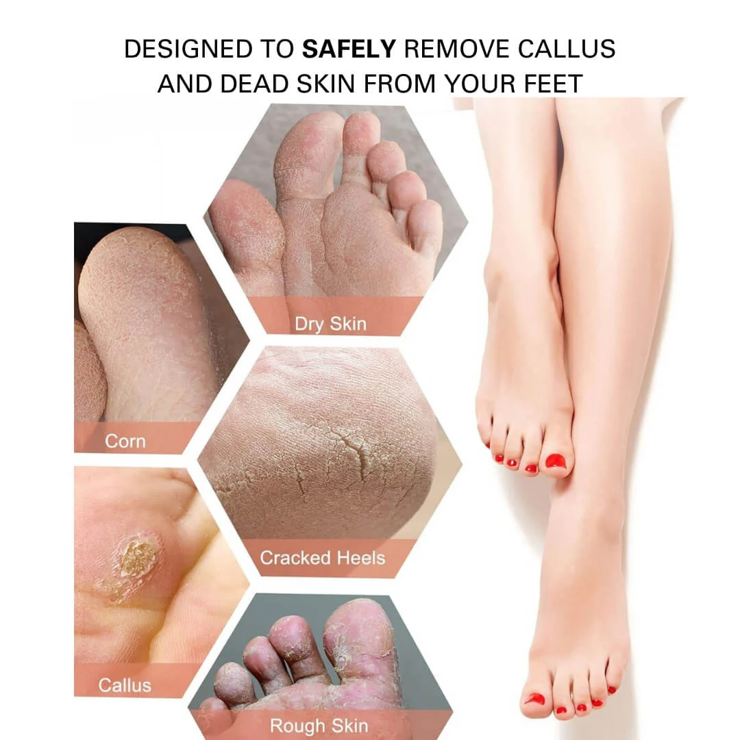 Blissal Rechargeable Foot Callus Remover - Image 4